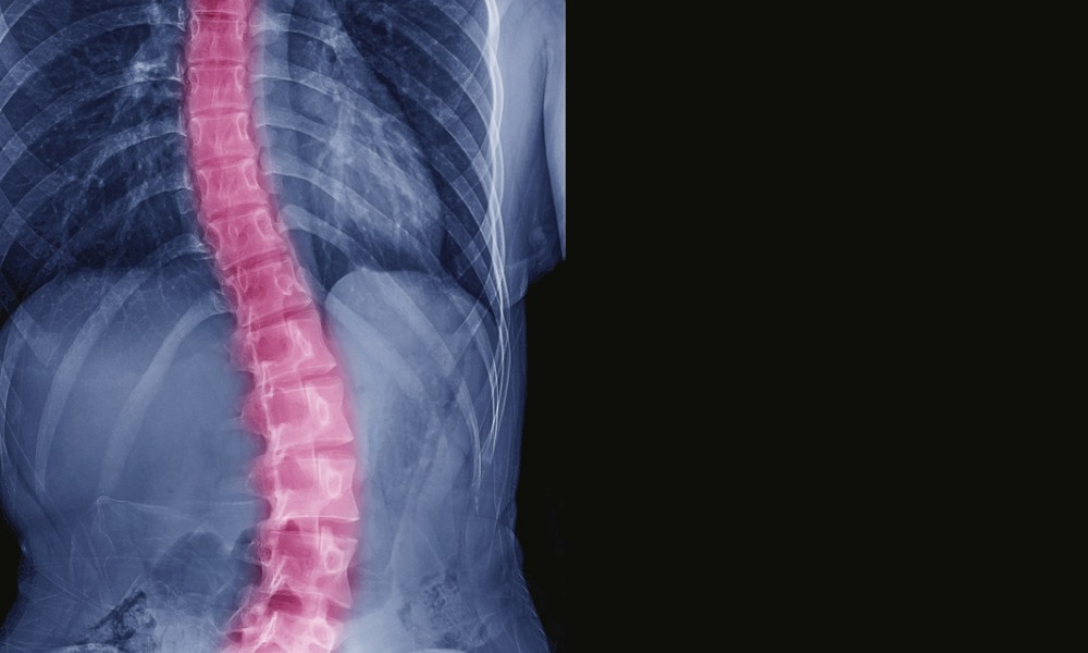 Scoliosis 101: What You Need To Know