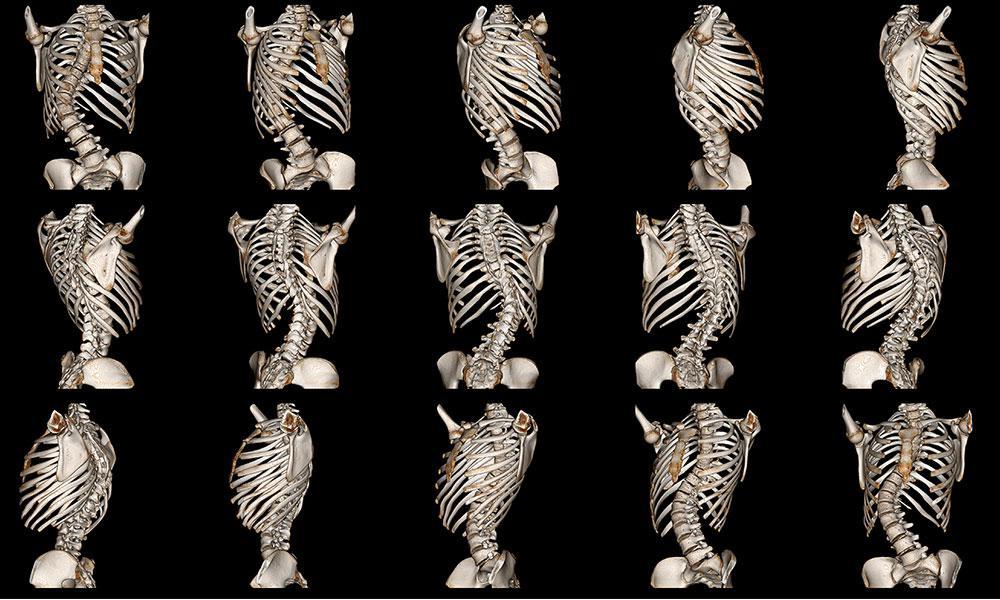 4 Questions Answered About Scoliosis