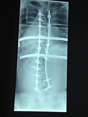 spine alignment x-ray