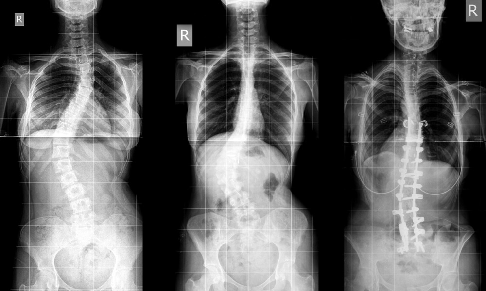 When Does Scoliosis Require Surgery?