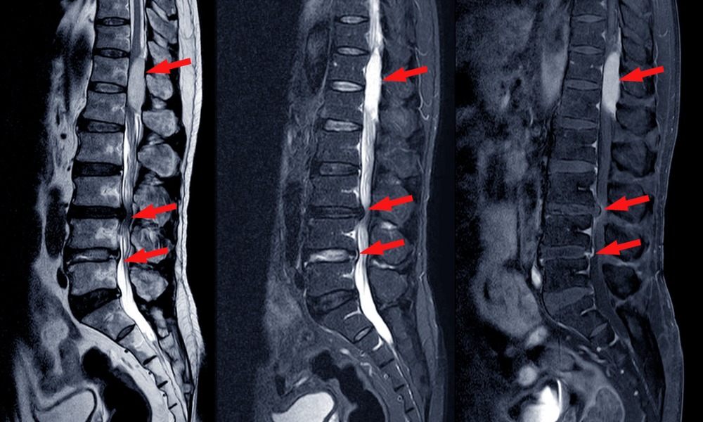 Spinal Stenosis Symptoms To Be Aware Of